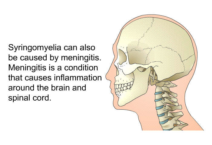 Syringomyelia can also be caused by meningitis. Meningitis is a condition that causes inflammation around the brain and spinal cord.