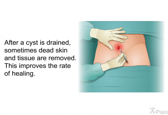 After a cyst is drained, sometimes dead skin and tissue are removed. This improves the rate of healing.