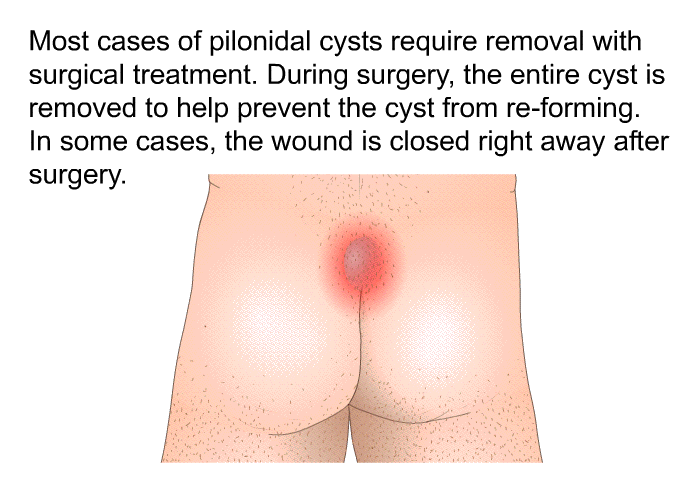 Most cases of pilonidal cysts require removal with surgical treatment. During surgery, the entire cyst is removed to help prevent the cyst from re-forming. In some cases, the wound is closed right away after surgery.