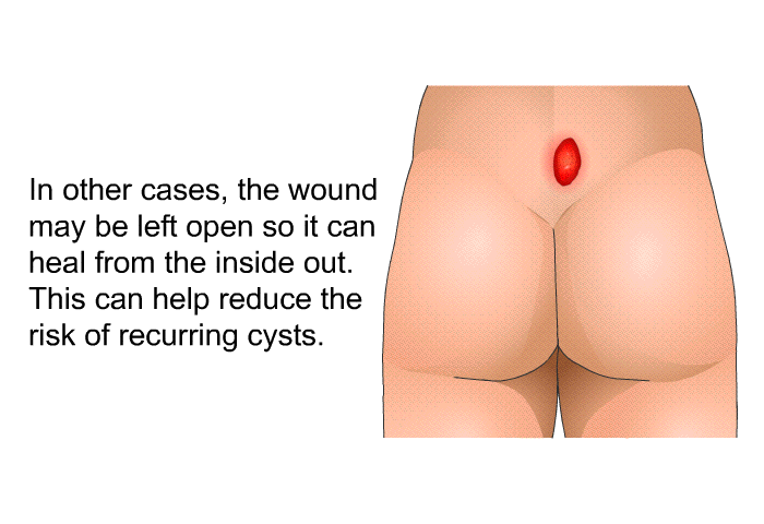 In other cases, the wound may be left open so it can heal from the inside out. This can help reduce the risk of recurring cysts.