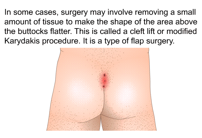 In some cases, surgery may involve removing a small amount of tissue to make the shape of the area above the buttocks flatter. This is called a cleft lift or modified Karydakis procedure. It is a type of flap surgery.