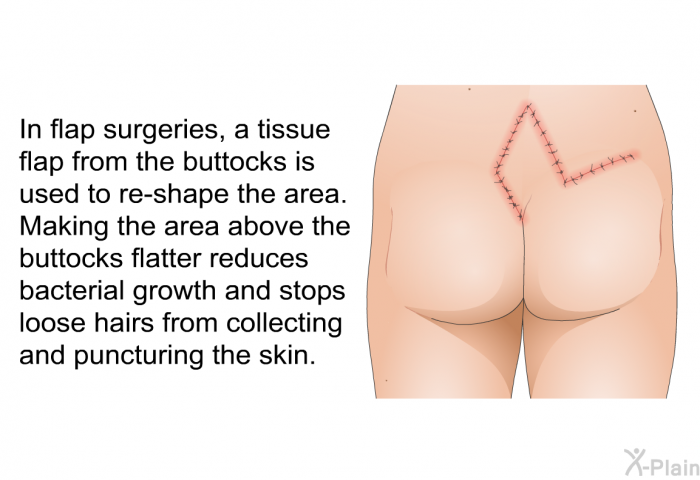 In flap surgeries, a tissue flap from the buttocks is used to re-shape the area. Making the area above the buttocks flatter reduces bacterial growth and stops loose hairs from collecting and puncturing the skin.