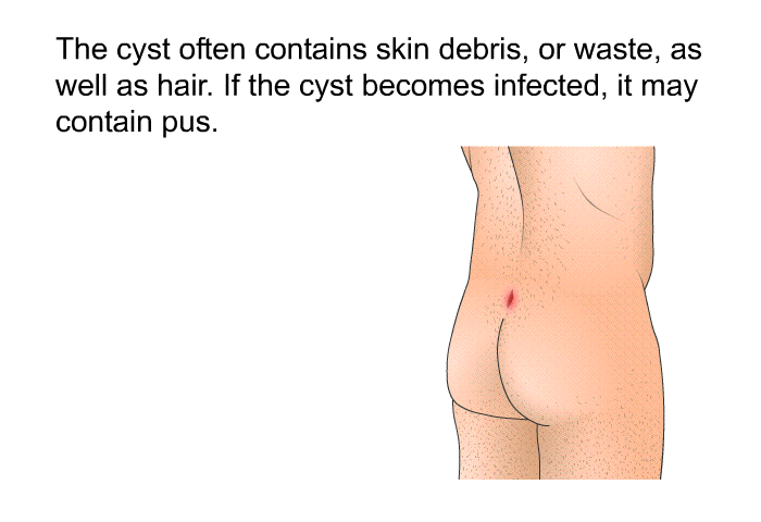 The cyst often contains skin debris, or waste, as well as hair. If the cyst becomes infected, it may contain pus.