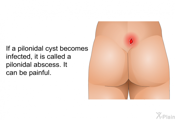 If a pilonidal cyst becomes infected, it is called a pilonidal abscess. It can be painful.