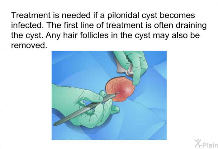 Treatment is needed if a pilonidal cyst becomes infected. The first line of treatment is often draining the cyst. Any hair follicles in the cyst may also be removed.