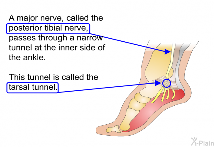 A major nerve, called the posterior tibial nerve, passes through a narrow tunnel at the inner side of the ankle. This tunnel is called the tarsal tunnel.