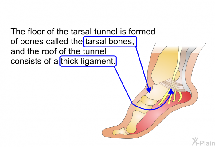The floor of the tarsal tunnel is formed of bones called the tarsal bones, and the roof of the tunnel consists of a thick ligament.