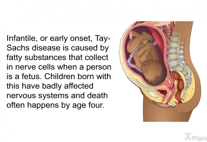 Infantile, or early onset, Tay-Sachs disease is caused by fatty substances that collect in nerve cells when a person is a fetus. Children born with this have badly affected nervous systems and death often happens by age four.
