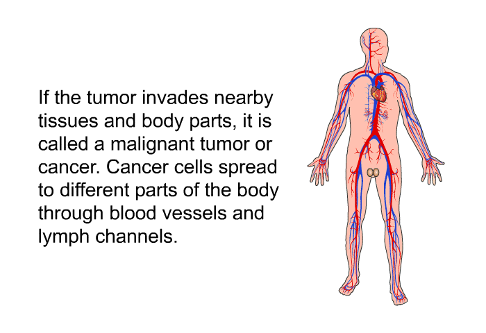 If the tumor invades nearby tissues and body parts, it is called a malignant tumor or cancer. Cancer cells spread to different parts of the body through blood vessels and lymph channels.