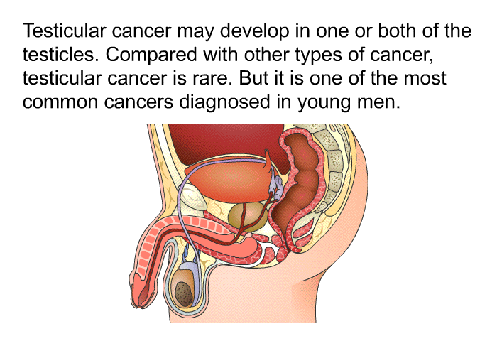 Testicular cancer may develop in one or both of the testicles. Compared with other types of cancer, testicular cancer is rare. But it is one of the most common cancers diagnosed in young men.