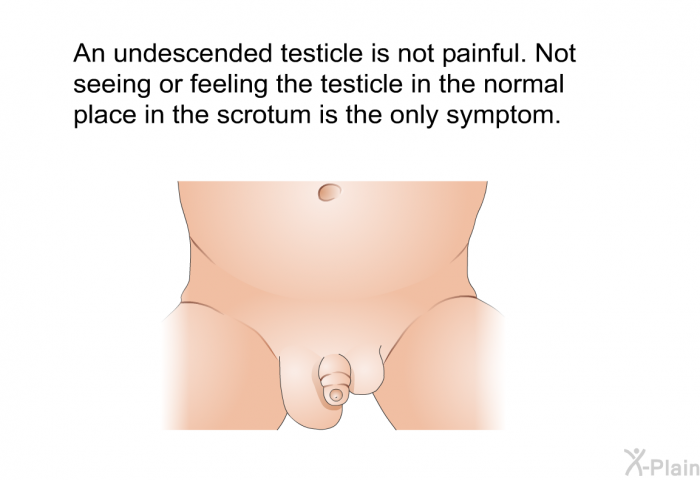 An undescended testicle is not painful. Not seeing or feeling the testicle in the normal place in the scrotum is the only symptom.