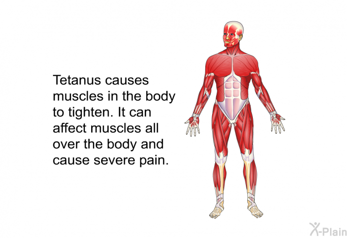 Tetanus causes muscles in the body to tighten. It can affect muscles all over the body and cause severe pain.