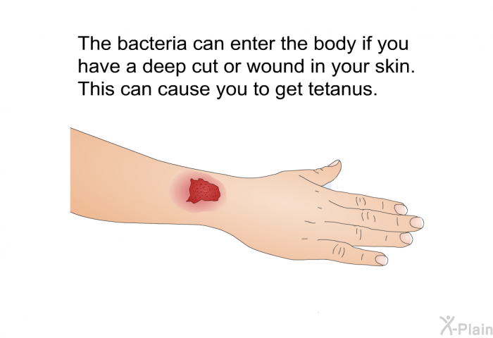 The bacteria can enter the body if you have a deep cut or wound in your skin. This can cause you to get tetanus.