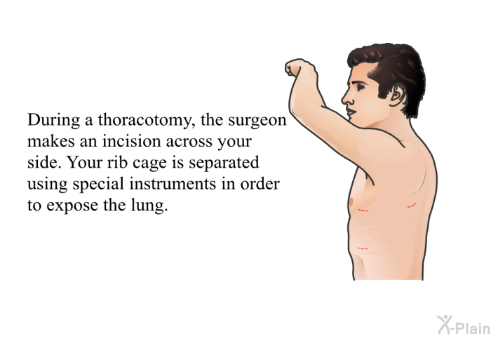 During a thoracotomy, the surgeon makes an incision across your side. Your rib cage is separated using special instruments in order to expose the lung.