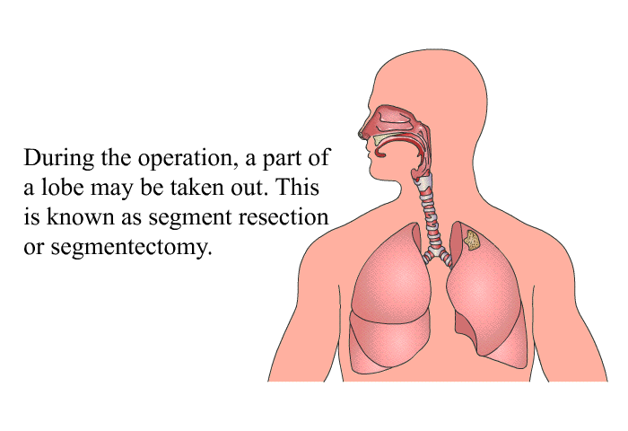 During the operation, a part of a lobe may be taken out. This is known as segment resection or segmentectomy.