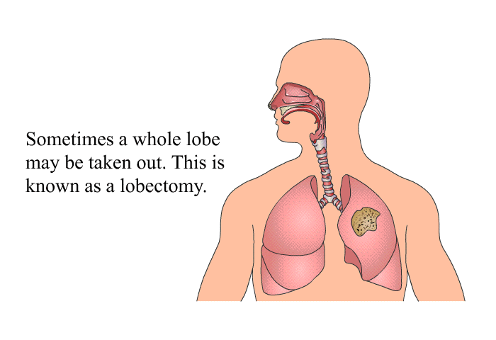 Sometimes a whole lobe may be taken out. This is known as a lobectomy.