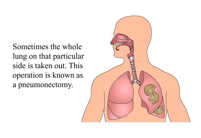 Sometimes the whole lung on that particular side is taken out. This operation is known as a pneumonectomy.