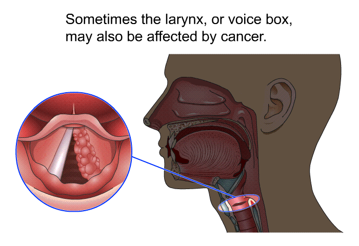 Sometimes the larynx, or voice box, may also be affected by cancer.