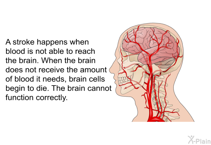 A stroke happens when blood is not able to reach the brain. When the brain does not receive the amount of blood it needs, brain cells begin to die. The brain cannot function correctly.