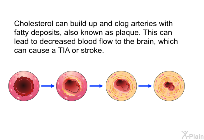 Cholesterol can build up and clog arteries with fatty deposits, also known as plaque. This can lead to decreased blood flow to the brain, which can cause a TIA or stroke.