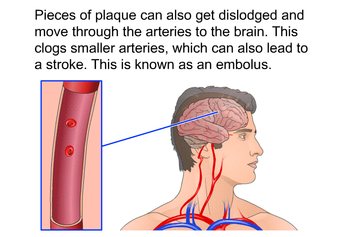 Pieces of plaque can also get dislodged and move through the arteries to the brain. This clogs smaller arteries, which can also lead to a stroke. This is known as an embolus.