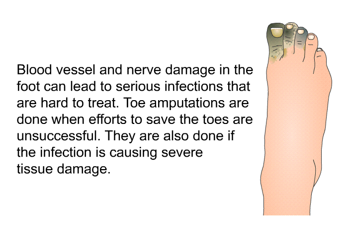 Blood vessel and nerve damage in the foot can lead to serious infections that are hard to treat. Toe amputations are done when efforts to save the toes are unsuccessful. They are also done if the infection is causing severe tissue damage.