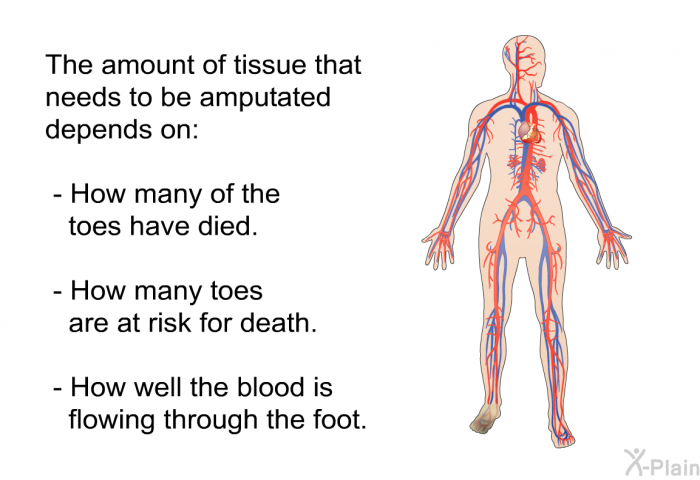 The amount of tissue that needs to be amputated depends on:  How many of the toes have died. How many toes are at risk for death. How well the blood is flowing through the foot.