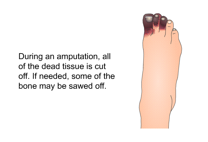 During an amputation, all of the dead tissue is cut off. If needed, some of the bone may be sawed off.