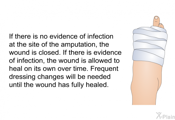 If there is no evidence of infection at the site of the amputation, the wound is closed. If there is evidence of infection, the wound is allowed to heal on its own over time. Frequent dressing changes will be needed until the wound has fully healed.