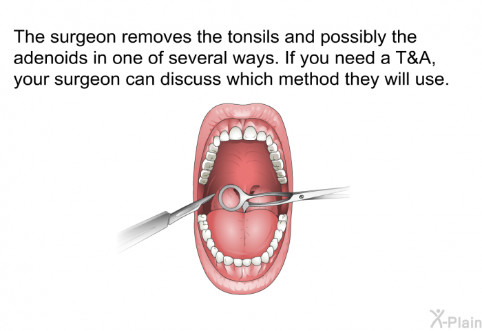 The surgeon removes the tonsils and possibly the adenoids in one of several ways. If you need a T&A, your surgeon can discuss which method they will use.