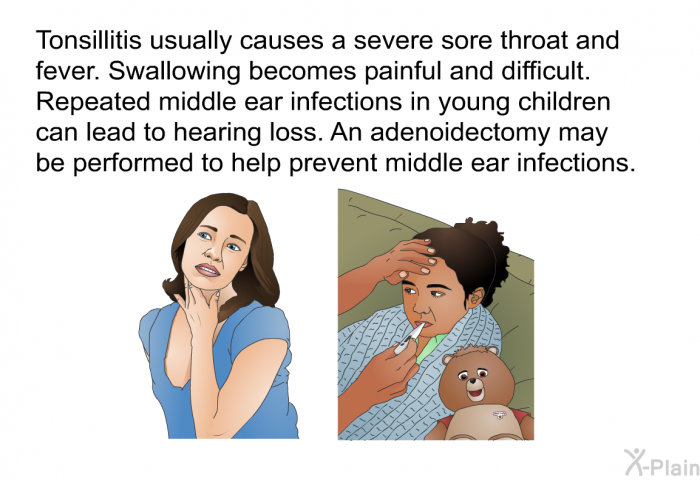 Tonsillitis usually causes a severe sore throat and fever. Swallowing becomes painful and difficult. Repeated middle ear infections in young children can lead to hearing loss. An adenoidectomy may be performed to help prevent middle ear infections.