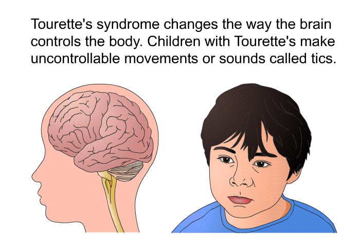 Tourette's syndrome changes the way the brain controls the body. Children with Tourette's make uncontrollable movements or sounds called tics.
