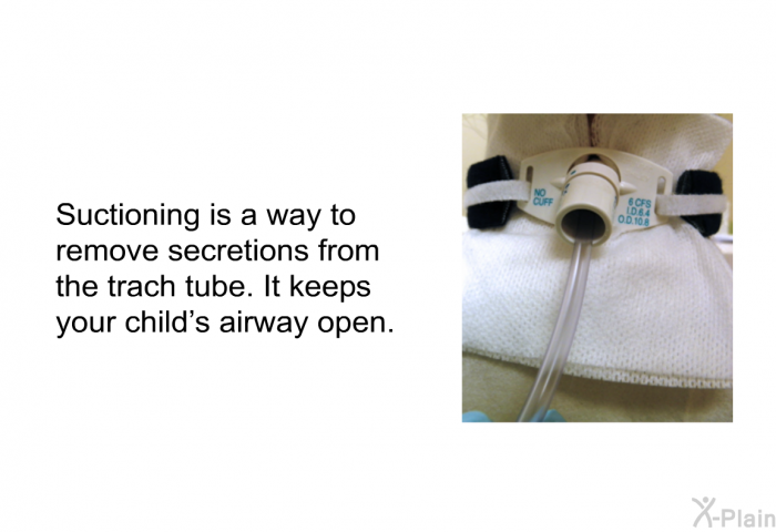 Suctioning is a way to remove secretions from the trach tube. It keeps your child's airway open.