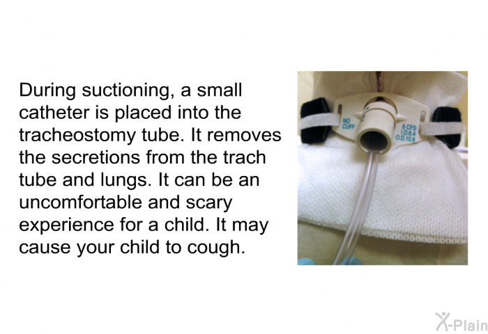 During suctioning, a small catheter is placed into the tracheostomy tube. It removes the secretions from the trach tube and lungs. It can be an uncomfortable and scary experience for a child. It may cause your child to cough.