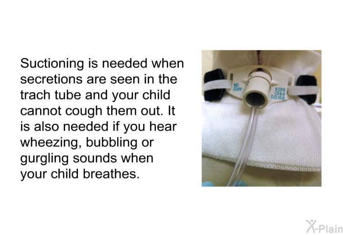 Suctioning is needed when secretions are seen in the trach tube and your child cannot cough them out. It is also needed if you hear wheezing, bubbling or gurgling sounds when your child breathes.