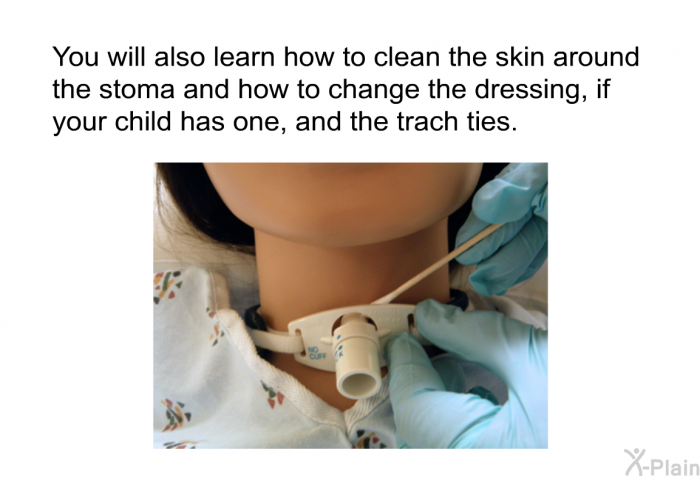 You will also learn how to clean the skin around the stoma and how to change the dressing, if your child has one, and the trach ties.