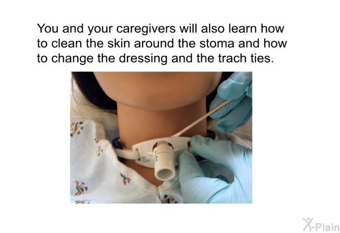 You and your caregivers will also learn how to clean the skin around the stoma and how to change the dressing and the trach ties.
