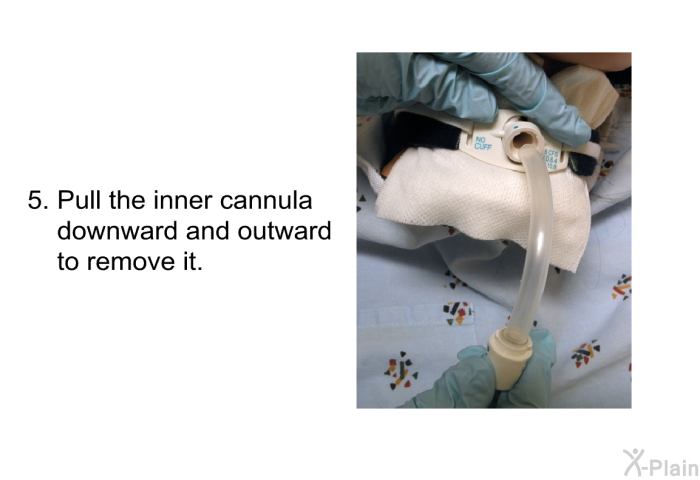 Pull the inner cannula downward and outward to remove it.