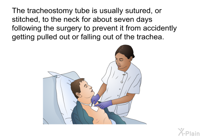 The tracheostomy tube is usually sutured, or stitched,<B> </B>to the neck for about seven days following the surgery to prevent it from accidently getting pulled out or falling out of the trachea.