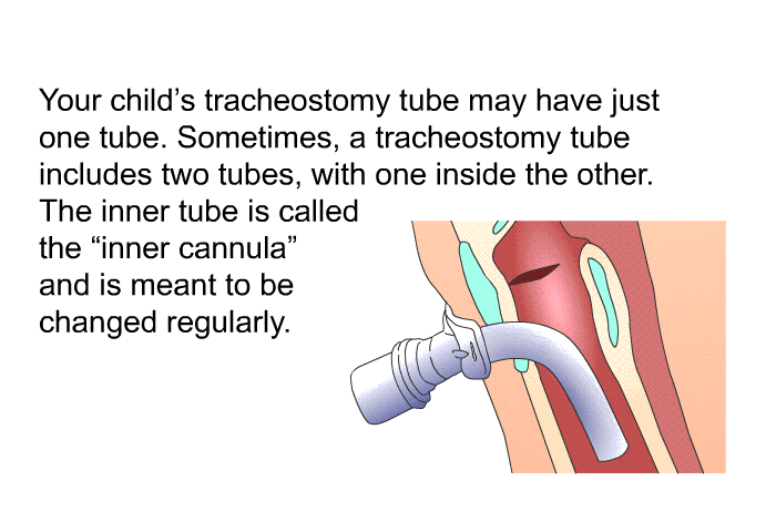 Your child’s tracheostomy tube may just have one tube. Sometimes, a tracheostomy tube includes two tubes, with one inside the other. The inner tube is called the “inner cannula” and is meant to be changed regularly.