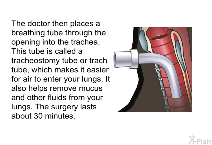 The doctor then places a breathing tube through the opening into the trachea. This tube is called a tracheostomy tube or trach tube, which makes it easier for air to enter your lungs. It also helps remove mucus and other fluids from your lungs. The surgery lasts about 30 minutes.