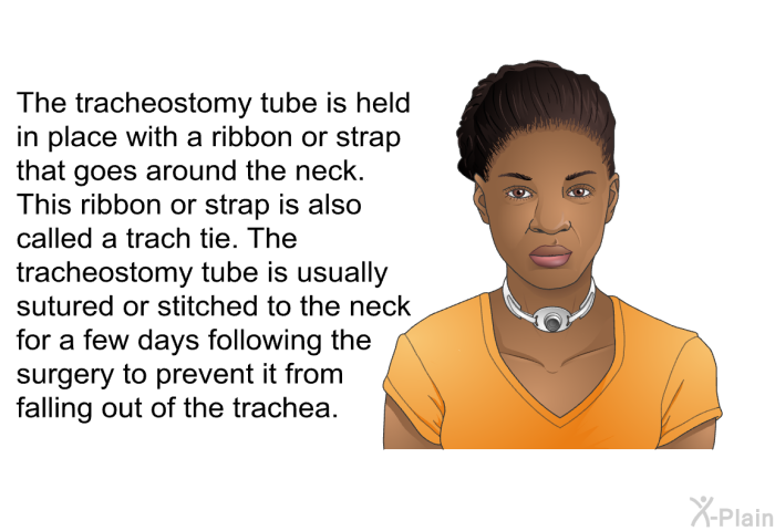 The tracheostomy tube is held in place with a ribbon or strap that goes around the neck. This ribbon or strap is also called a trach tie. The tracheostomy tube is usually sutured or stitched to the neck for a few days following the surgery to prevent it from falling out of the trachea.