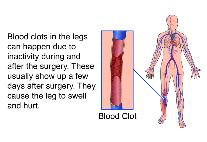 Blood clots in the legs can happen due to inactivity during and after the surgery. These usually show up a few days after surgery. They cause the leg to swell and hurt.