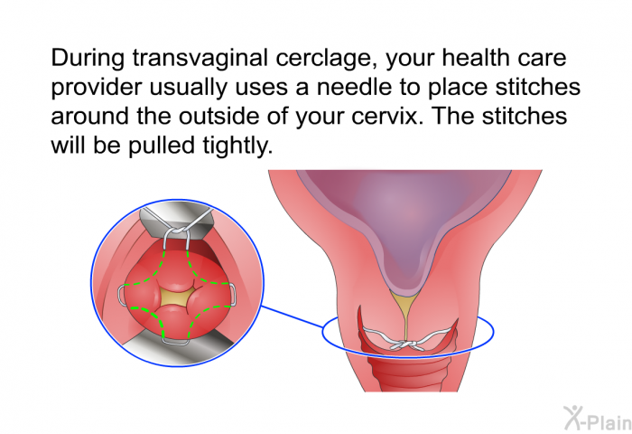 During transvaginal cerclage, your health care provider usually uses a needle to place stitches around the outside of your cervix. The stitches will be pulled tightly.