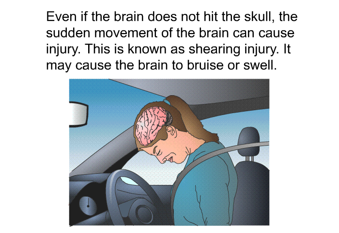 Even if the brain does not hit the skull, the sudden movement of the brain can cause injury. This is known as shearing injury. It may cause the brain to bruise or swell.