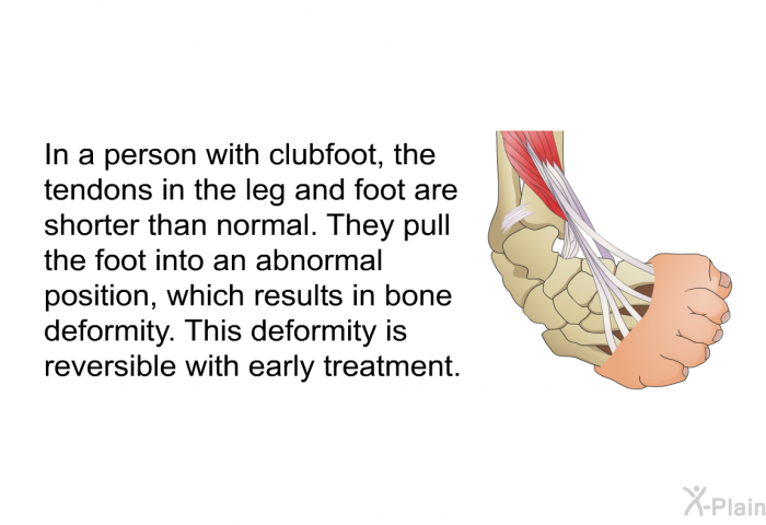 In a person with clubfoot, the tendons in the leg and foot are shorter than normal. They pull the foot into an abnormal position, which results in bone deformity. This deformity is reversible with early treatment.