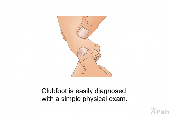 Clubfoot is easily diagnosed with a simple physical exam.