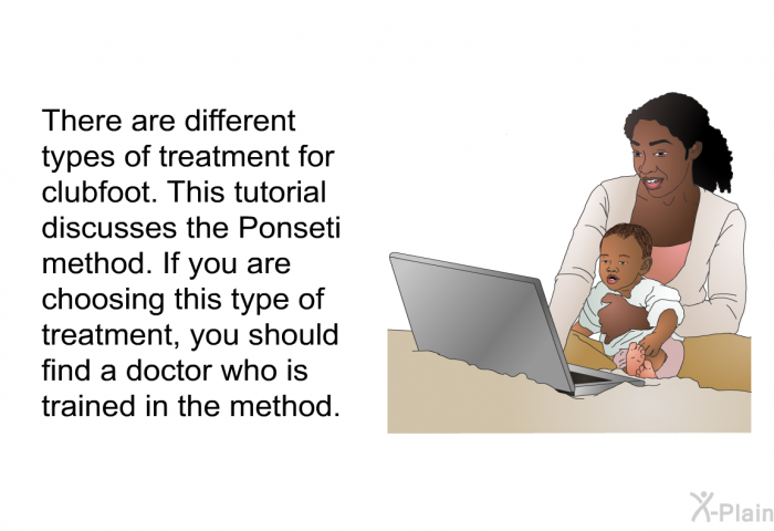 There are different types of treatment for clubfoot. This health information discusses the Ponseti method. If you are choosing this type of treatment, you should find a doctor who is trained in the method.