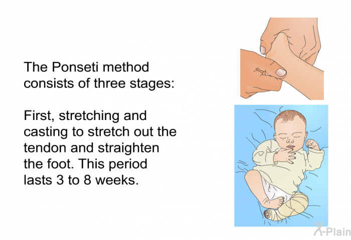 The Ponseti method consists of three stages: First, stretching and casting to stretch out the tendon and straighten the foot. This period lasts 3 to 8 weeks.