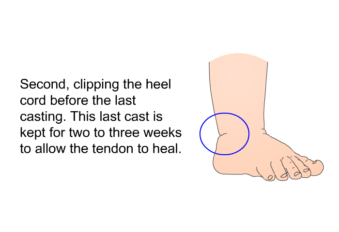 Second, clipping the heel cord before the last casting. This last cast is kept for two to three weeks to allow the tendon to heal.